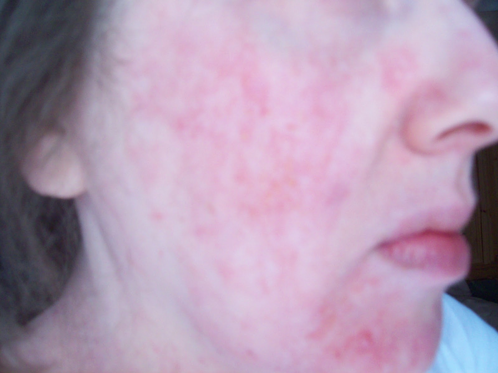 Topical Steroid Withdrawal: May 2012
